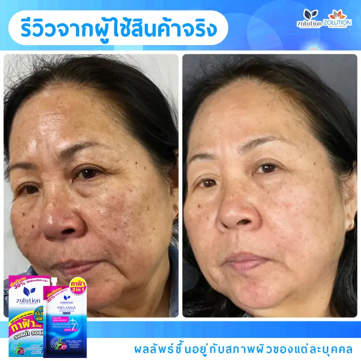 รีวิวก่อน-หลัง ผู้ใช้ครีมทาฝ้าซองน้ำเงิน 1