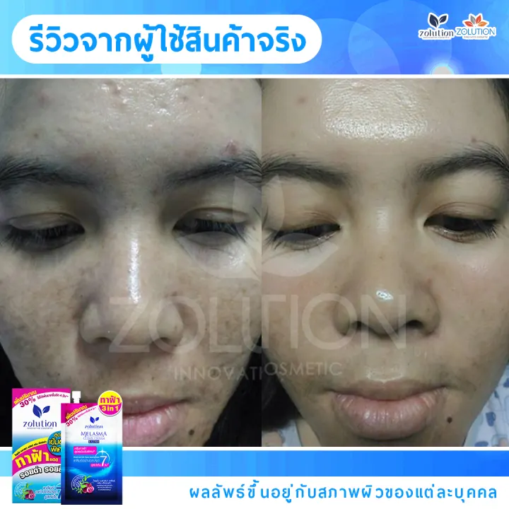 รีวิวก่อน-หลัง ผู้ใช้ครีมทาฝ้าซองน้ำเงิน 3